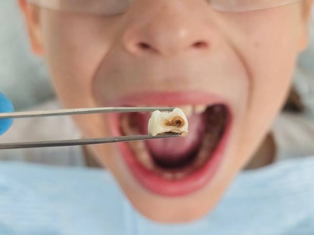 Best Emergency Dental Care for Broken or Chipped Teeth in Hutchinson Island South, FL